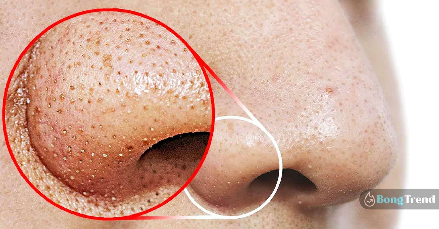 Remove Blackheads with home remedy