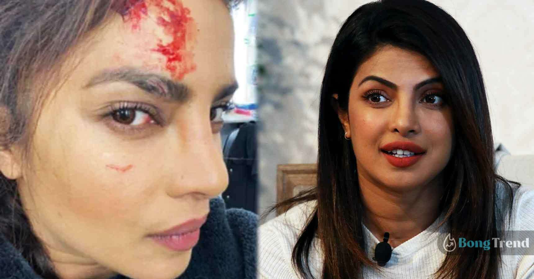 Priyanka Chopra,প্রিয়াঙ্কা চোপড়া,Injured,জখম,Citadel,সিটাডেল,Web Series,ওয়েব সিরিজ,Priyanka Chopra Injured while shooting of Citadel web series