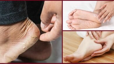 Foot Care in Winter Home Remedy
