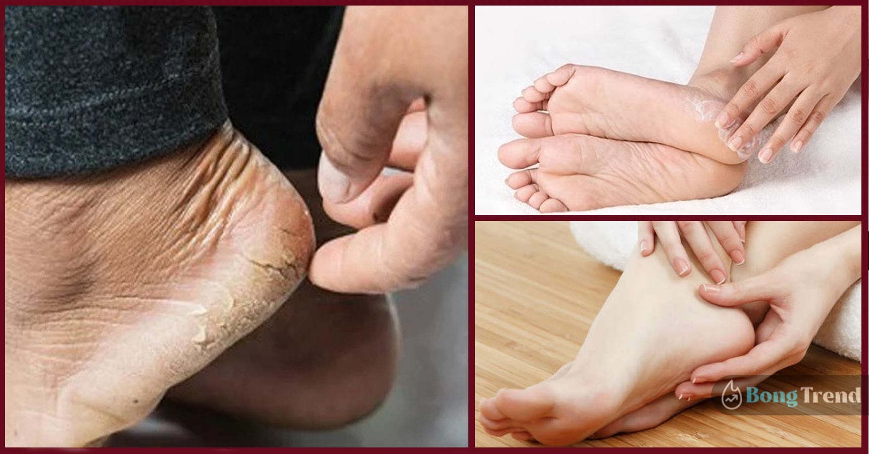 Foot Care in Winter Home Remedy