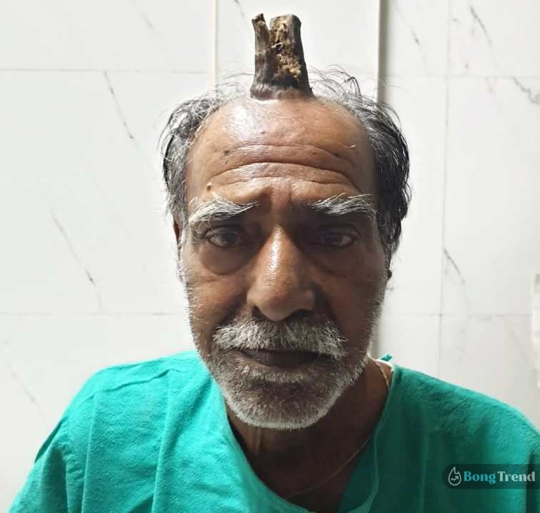 Four-inch devil horn removed from man’s head in hospital,Man had horn,Indian man had horn in foreghead,What is devil horn,বৃদ্ধের মাথায় শিং,ভাইরাল খবর,Viral News,Cutaneous Horn,Skin Diseases