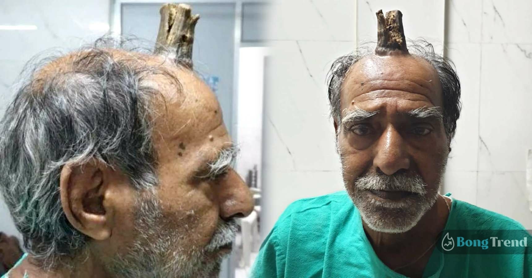 MP Man with Four Inch Devil horn gets it removed in hospital Viral News