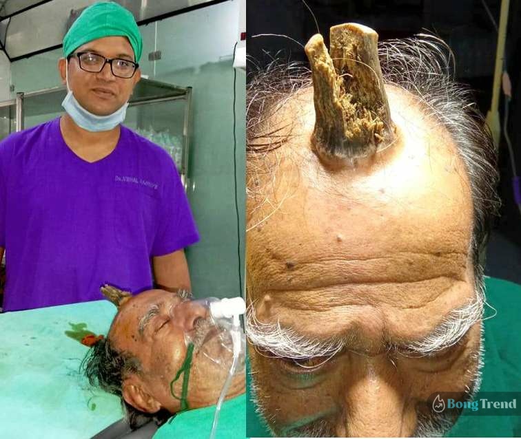 Four-inch devil horn removed from man’s head in hospital,Man had horn,Indian man had horn in foreghead,What is devil horn,বৃদ্ধের মাথায় শিং,ভাইরাল খবর,Viral News,Cutaneous Horn,Skin Diseases