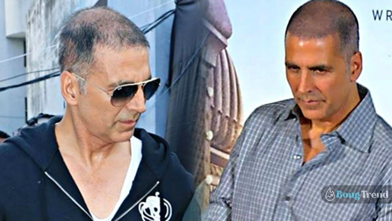 akshay kumar,bollywood,akshay kumar hair transplant,khiladi,অক্ষয় কুমার,বলিউড,অক্ষয় কুমার হেয়ার ট্রান্সপ্লান্ট,খিলাড়ি