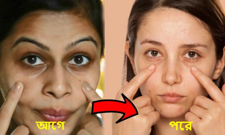 get rid of dark circles under eye with these easy home remedies