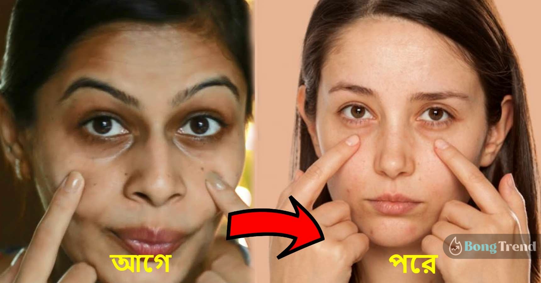 get rid of dark circles under eye with these easy home remedies