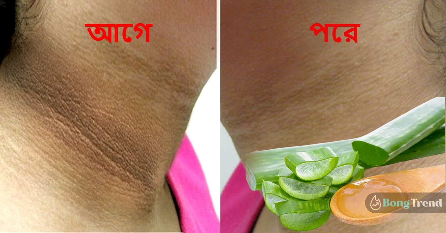 remove black spots from neck home remedy