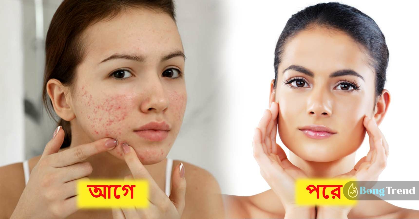 how to Get Rid off Pimples naturally