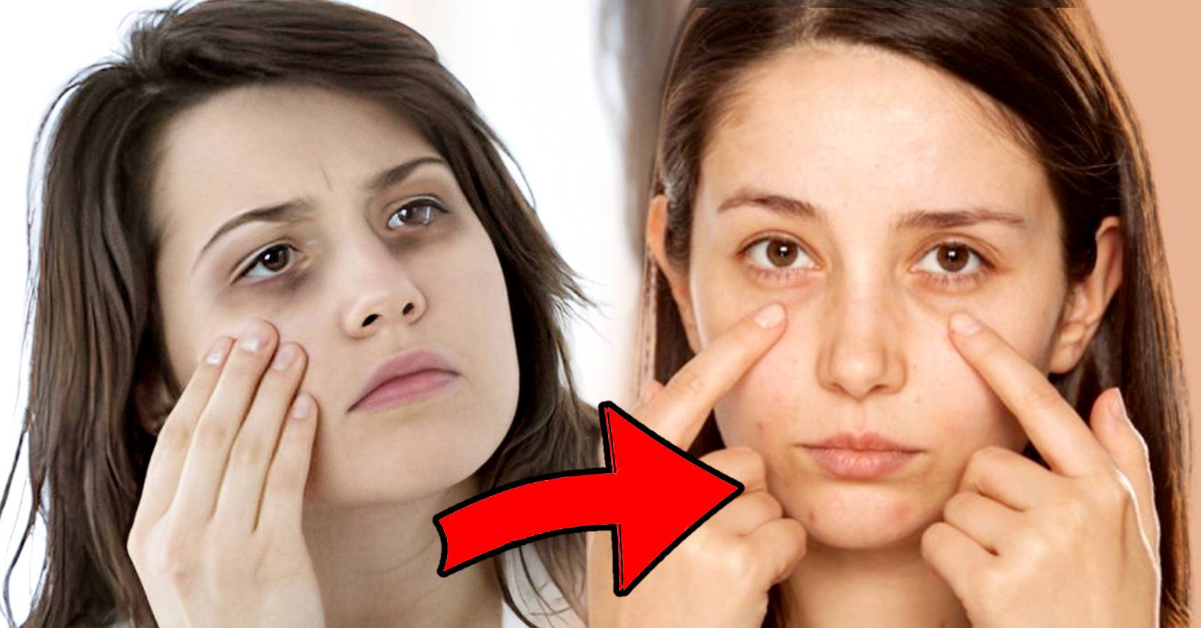 Remove Dark Circles under eye within 7 days following these home remedies
