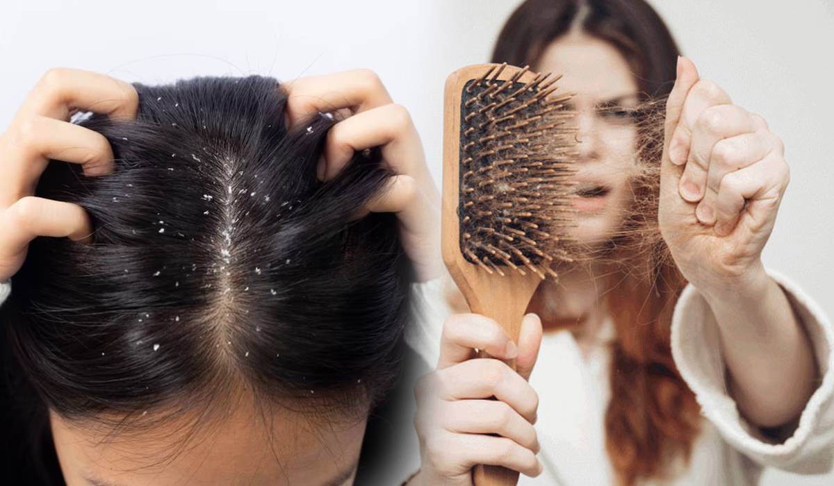 Hair fall and dandruff, Hair care tips in monsoon