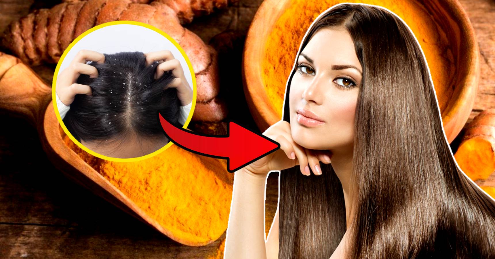 5 homemade hair masks to cure dandruff problem in monsoon