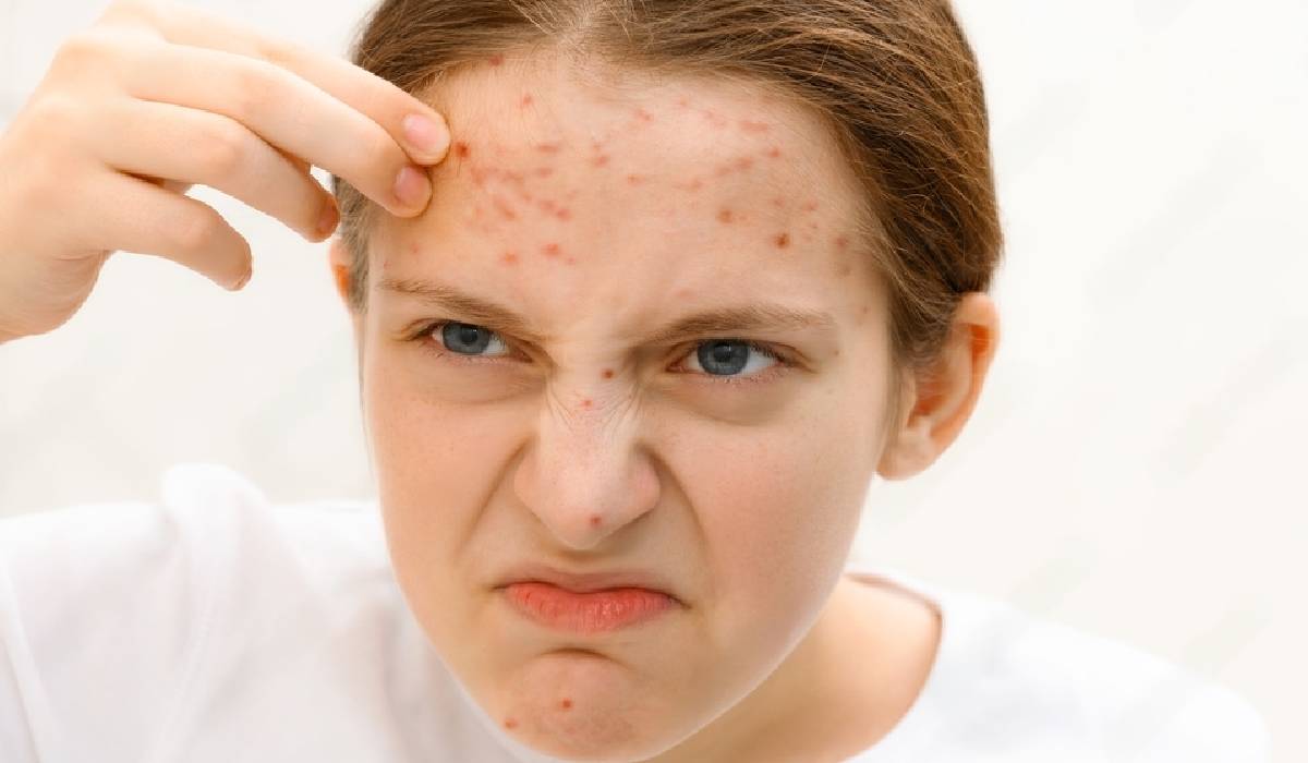 Forehead acne, How to reduce Forehead acne