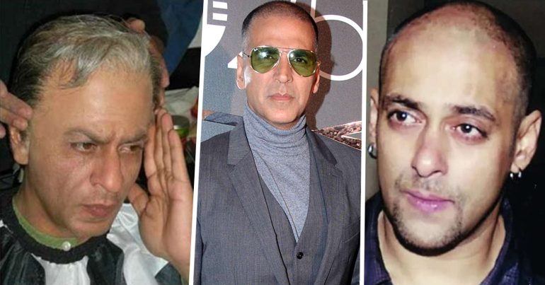 Shocking photos of Bollywood Actor's before and after hair transplant look